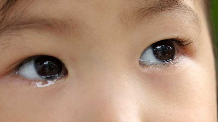 ドライアイとは